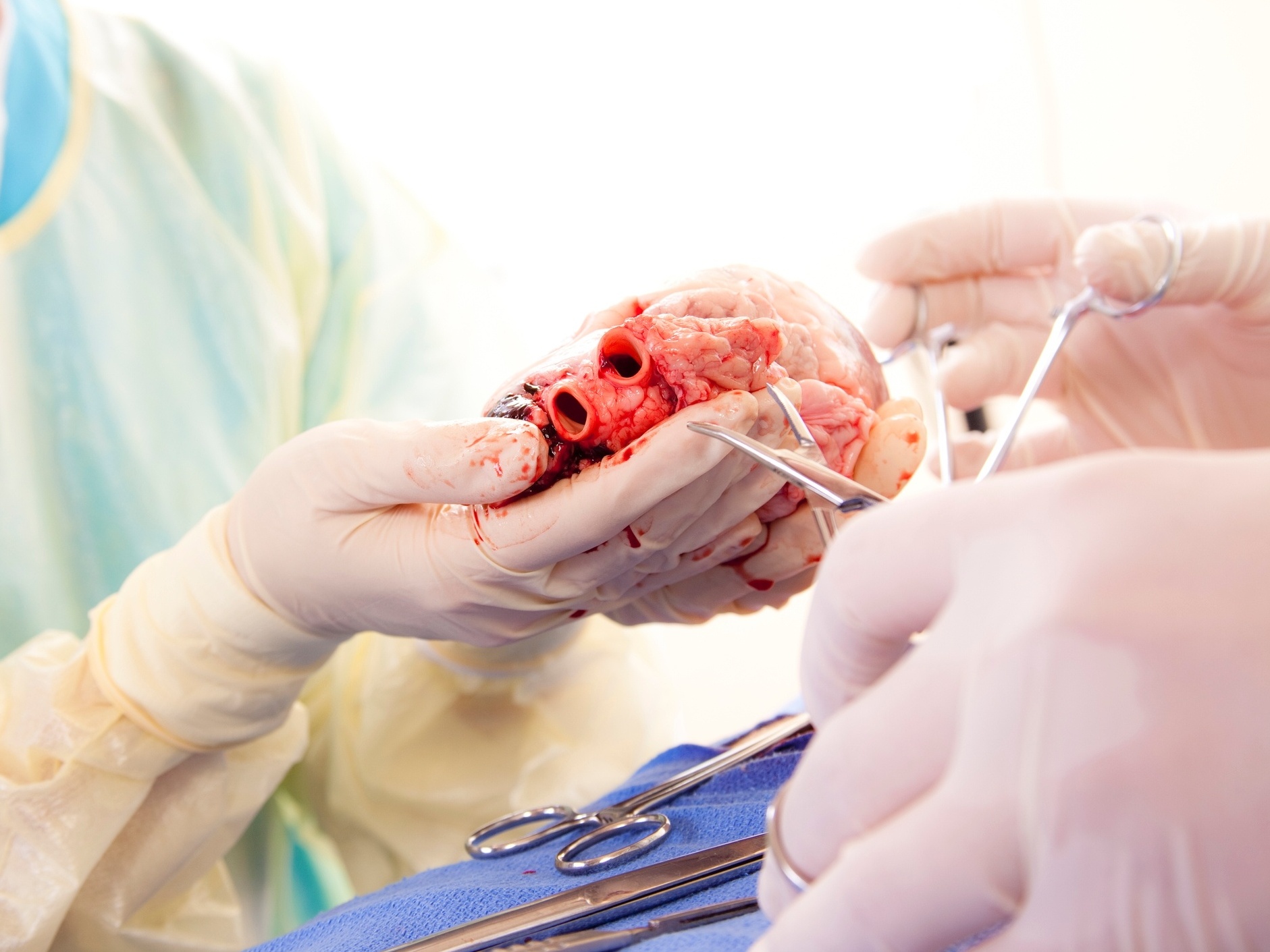 Transplante de coração: o que acontece se o órgão for rejeitado?