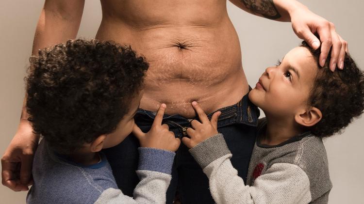Não é questão de estética | Cicatriz da cesárea faz mulheres sofrerem, e isso não é 'mimimi'