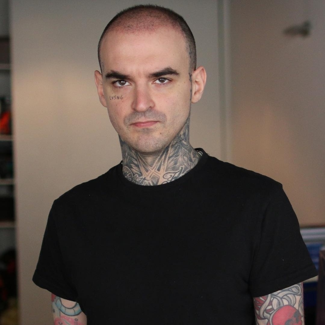 PC Siqueira fez cirurgia para estrabismo em 2016: como é operação?