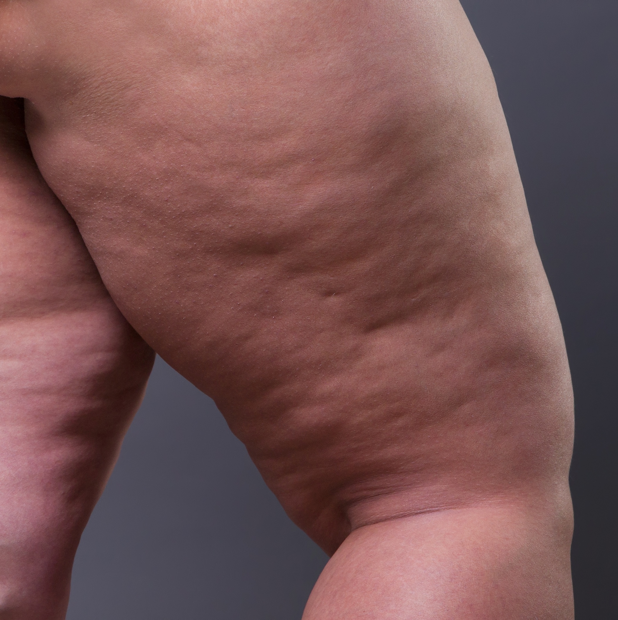 O lipedema é uma inflamação de baixo grau do tecido gorduroso. Lipedema não  é gordura.