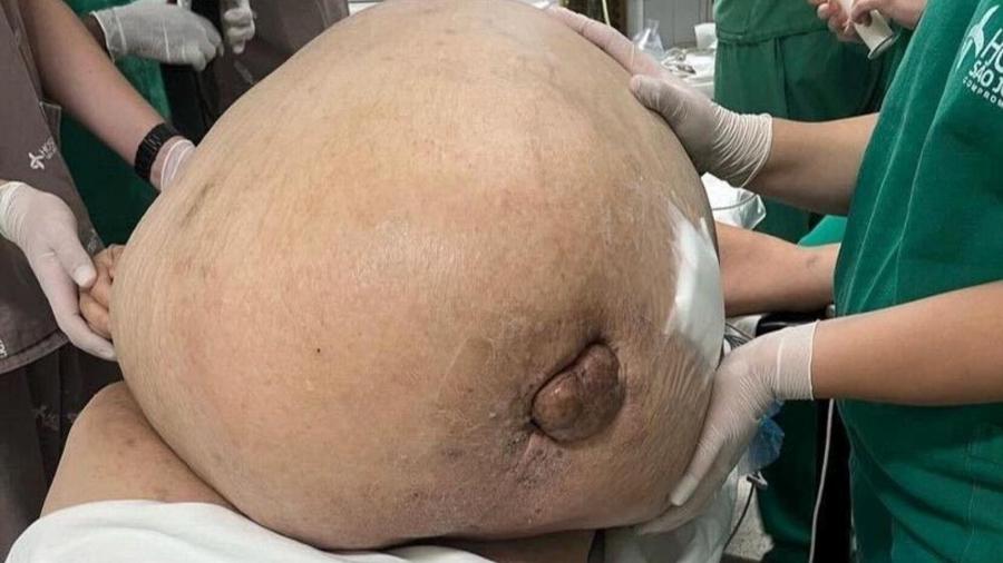 "Tumor gigante" encontrado em paciente é atípico, mas já acometeu outras pessoas ao redor do mundo - Arquivo Pessoal