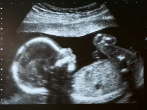 Dia de ultrassom deixa a mãe ansiosa: será que dará para ver a bebê? 