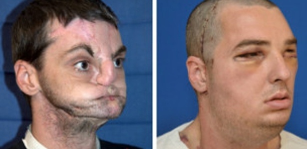 Richard Norris passou pelo transplante facial mais amplo já feito - AFP