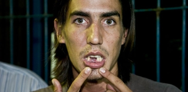 Ignácio Luján mostra a boca sem os três dentes que diz ter perdido durante agressão feitas por PMs - Myke Toscano/HiperNoticias