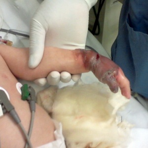 Bebê tem braço queimado por medicamento que vazou de sonda em hospital de Campinas - Arquivo pessoal