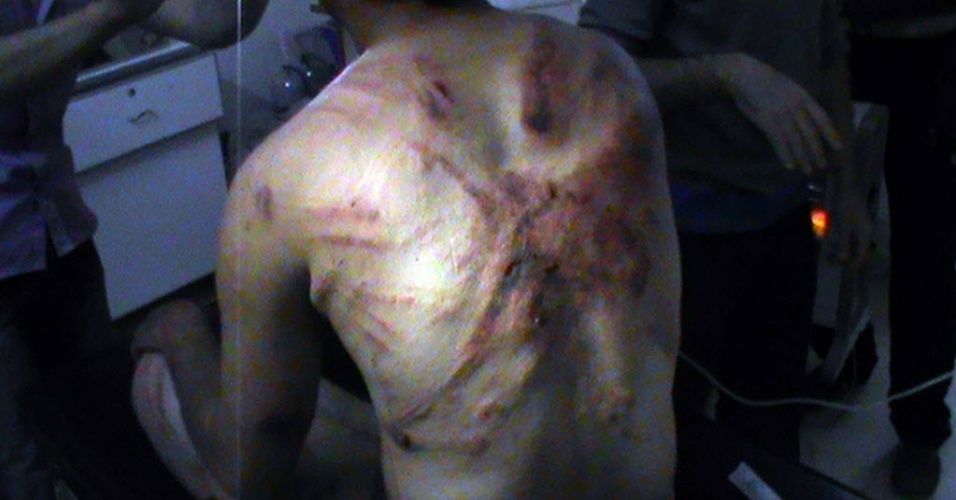 27.abr.2012 -Homem afirma ter sido torturado por soldados da força do regime sírio