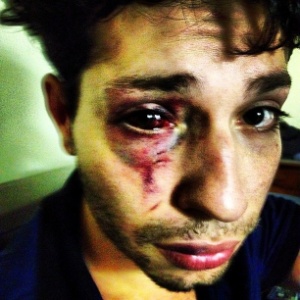 O cantor David Alvarez publicou foto no Facebook de seu rosto após a agressão - Divulgação/Facebook