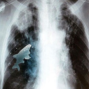 Médicos retiram peixe vivo de pulmão de garoto - The Sun/Reprodução