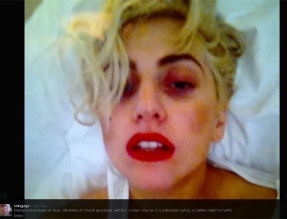 Lady Gaga publica no Twitter primeira após acidente em que foi atingida por uma barra de ferro durante show na Nova Zelândia, no último domingo (10), A barra de ferro que estava na mão de um dos dançarinos atingiu acidentalmente a cabeça da cantora. Pela foto, no entanto, não é possível saber se o acidente deixou hematomas na artista. "Emergindo de horas de sono. Ainda na dúvida se eu deveria ir lá fora", escreveu Gaga ao lado da foto (12/6/12)