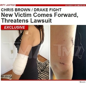 Mulher atingida por garrafa em briga de equipes de Chris Brown e Drake mostra machucados ao TMZ