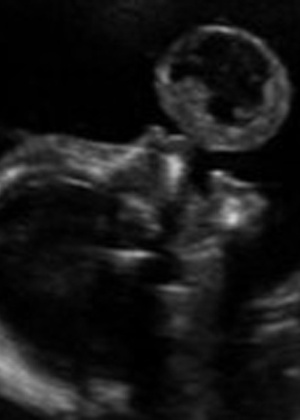 Em exame realizado às 17 semanas de gravidez, mãe viu "bolha" saindo da boca do feto - American Journal of Obstetrics Gynecology