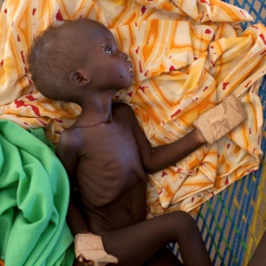 Criança sudanesa desnutrida é vista em campo de refugiados de Yida, no Sudão do Sul