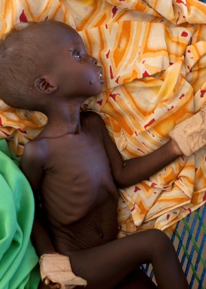 Criança sudanesa desnutrida é vista em campo de refugiados de Yida, no Sudão do Sul - Tyler Hicks / The New York Times