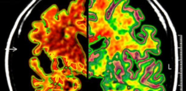 Pacientes com tendência a Alzheimer possuíam níveis anormais de uma proteína no cérebro.  - SPL