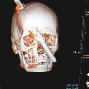 Quadro de saúde de operário que teve o crânio atravessado por um vergalhão é estável - Divulgação