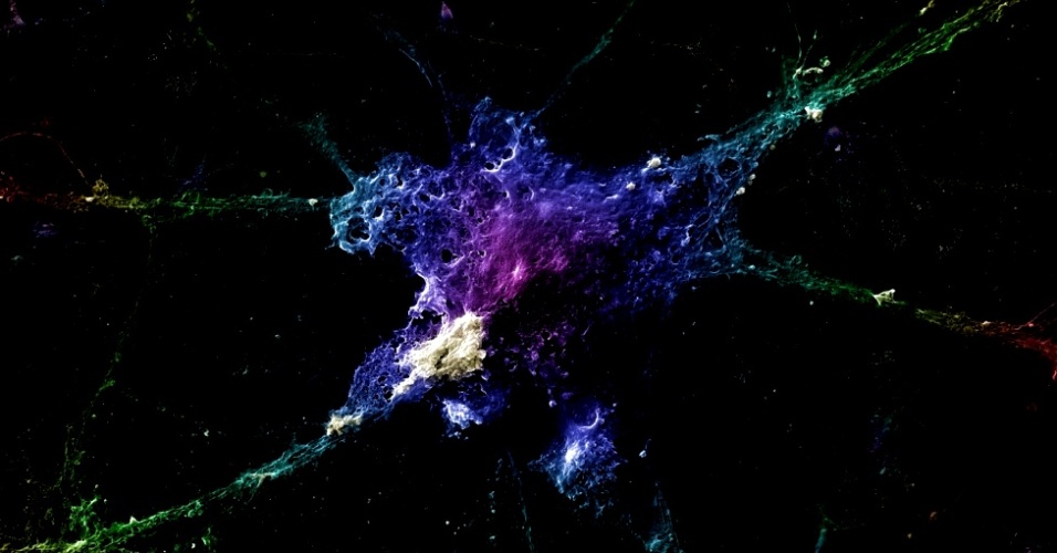 Este neurônio está sob o efeito da proteína beta-amilóide. A proteína gera uma placa, as chamadas placas de senilidade, que, acredita-se, seriam as principais causas da Doença de Alzheimer - Linnea Rundgren