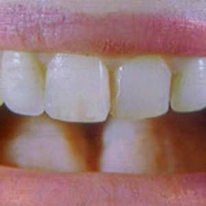 Deterioração dos dentes afeta até 90% de crianças em países industrializados - BBC