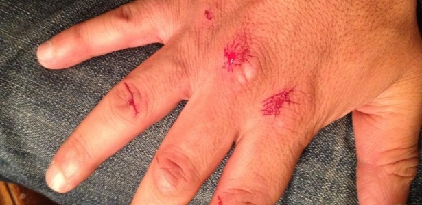 Renzo Gracie tira foto da sua mão, machucada após bater em dois ladrões - Reprodução/Twitter