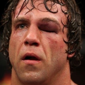 Norte-americano Kyle Kingsbury tem olho "fechado" por golpes e sua luta termina mais cedo - UFC/Divulgação
