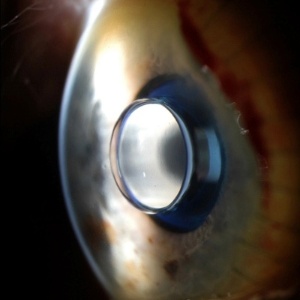 Microtelescópio do tamanho de uma ervilha foi implantado no olho - UC Davis
