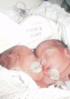 Rosie e Ruby Formosa nasceram unidas pelo abdome e compartilhavam parte do intestino - Divulgação/Great Ormond Street