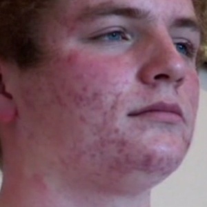 Will, jovem de 15 anos, disse em documentário da BBC que a acne afetou sua autoestima - BBC