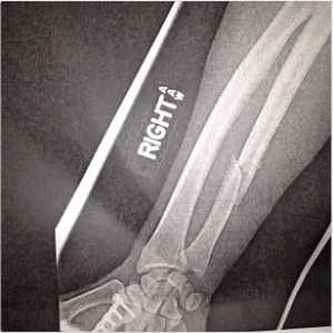 Raphael Assunção, do UFC, mostra fratura no braço sofrida durante luta; brasileiro venceu - Reprodução/Instagram