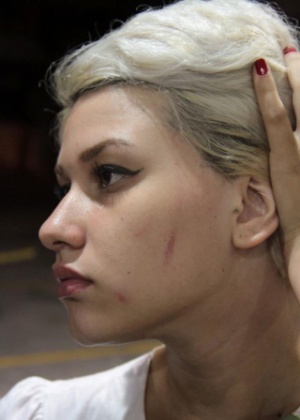 9.jan.2013 - Manifestante do Femen Brazil Sara Winter mostra ferimento em seu rosto; ela alega que a marca foi causada pelo sapato de um segurança do shopping que pisou em seu rosto
