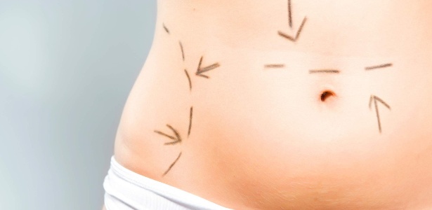 A lipoaspiração voltou a ser a cirurgia plástica mais realizada no Brasil, ultrapassando o aumento de mama - Thinkstock