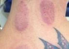 Blog: Levantadora do Vôlei Amil faz sangria para curar torcicolo - Reprodução/Instagram/fernandinha03