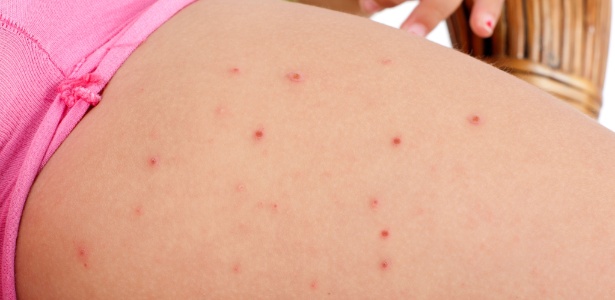 A acne solar é um problema típico do verão, porque as lesões surgem após a exposição excessiva ao sol - Getty Images