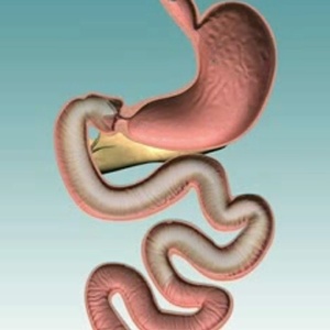 A técnica consiste em implantar um dispositivo impermeável para revestir o duodeno e excluir o papel dessa parte do intestino na digestão - Divulgação