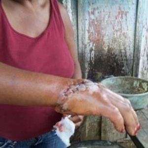 Mulher mostra mão ferida após ser resgatada  - Divulgação/MPT