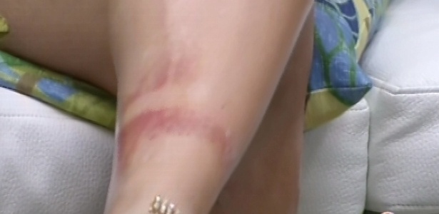 9.mar.2013 - Brothers observam manchas vermelhas na perna de Fernanda, que incharam e ficaram assim após mais de 12 horas em prova de resistência