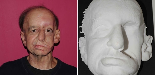 Eric Moger, 60, recebeu uma prótese facial para cobrir uma grande depressão causada por um tumor no rosto - Andrew Dawood