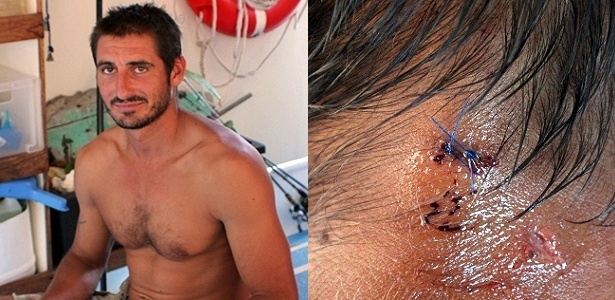 O francês Yoann Galeran, que escapou do ataque de um crocodilo; à esquerda, detalhe do ferimento na nuca - AFP