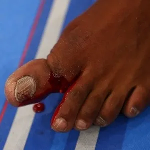 28.abr.2013 - Detalhe do dedo quebrado de Jon Jones após a luta contra Chael Sonnen no UFC 159 - Josh Hedges/Zuffa LLC/Zuffa LLC/Getty Images