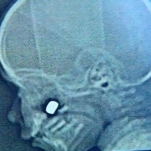 Raio-X mostra bala alojada em osso da face de garoto atingido por tiro acidental em Anápolis (GO) - Reprodução
