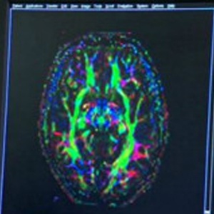 Ressonância magnética de cérebro de adolescente - Divulgação