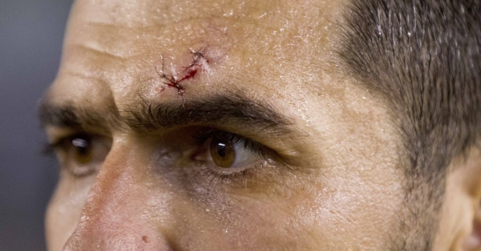 19.mai.2013 - Danilo, autor do gol do Corinthians na final do Paulistão, aparece com pontos na testa após sofrer um corte durante o jogo