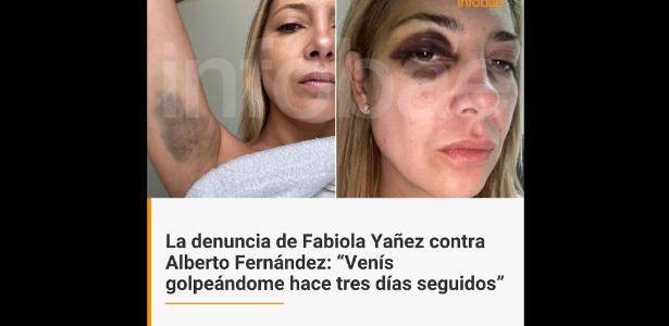 Fernandez says his ex-girlfriend's black eye was the result of cosmetic treatment