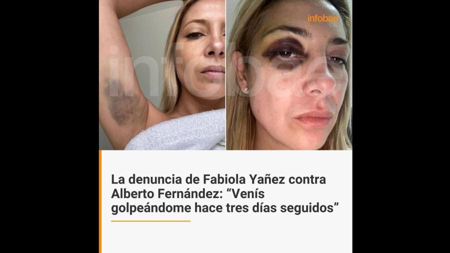 Imprensa argentina publicou fotos da ex-primeira dama argentina Fabíola Yañez machucada