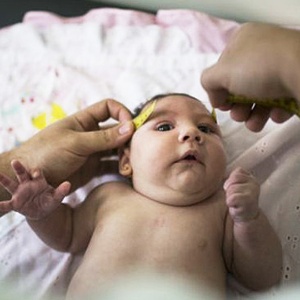 Vírus da zika causa microcefalia e outras complicações neurológicas em bebês - BBC/Associated Press