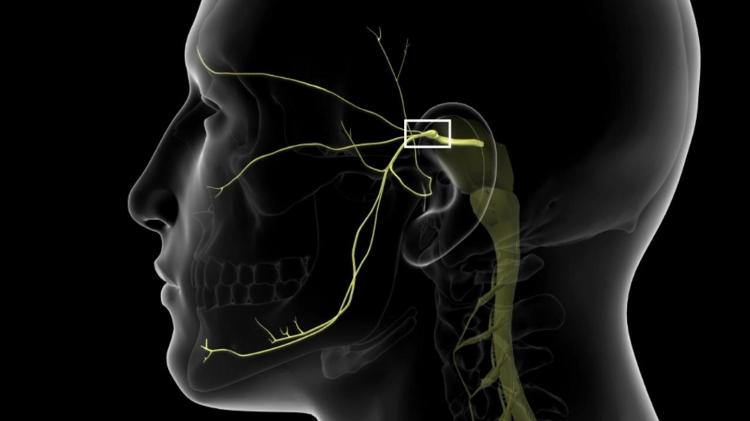 Neuralgia do trigêmeo é um quadro de dor associado a um nervo, o trigêmeo