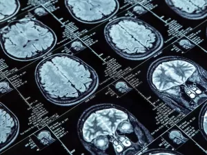 Estudo aponta 3 idades críticas em que o envelhecimento cerebral acelera