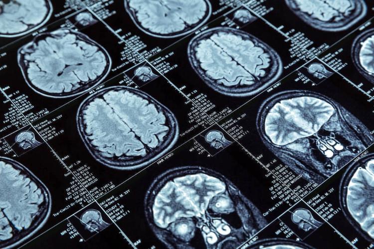 Cientistas estudam a possibilidade de que haja relação entre a presença de plásticos no meio ambiente e o maior desenvolvimento de demências, como o Alzheimer, na população global nos últimos anos