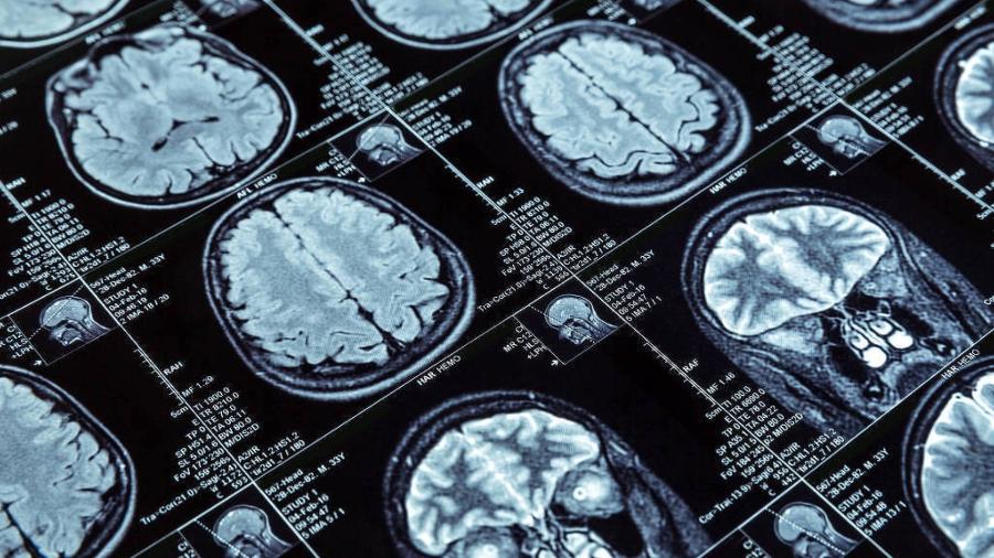 Ideia de que um lado do cérebro é mais importante que o outro é mito; cientistas dizem que as duas partes trabalham em conjunto