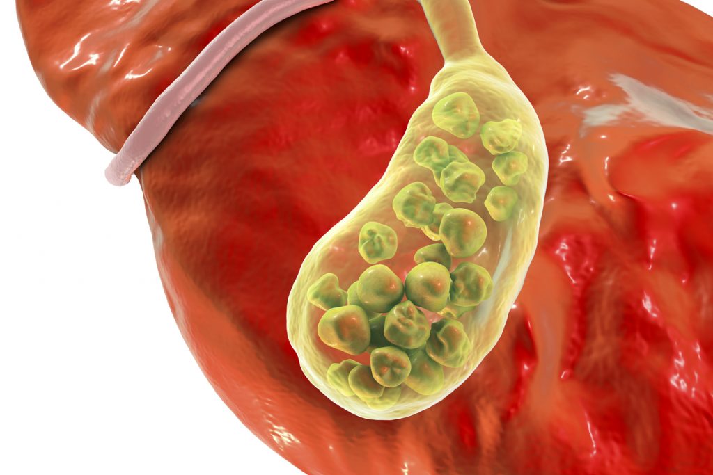 Quem fez cirurgia de vesícula pode se abaixar? Confira aqui!