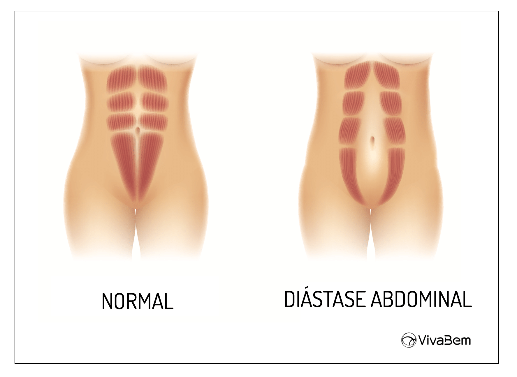 Diástase abdominal: quais exercícios melhoram o problema e quais evitar -  UOL VivaBem