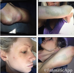 Jenna Reneé Webb mostra marcas que seriam de agressões de Travis Browne, em seu Instagram
